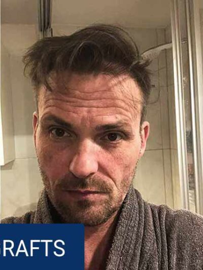 Hair transplant result after 12 months — full density restored