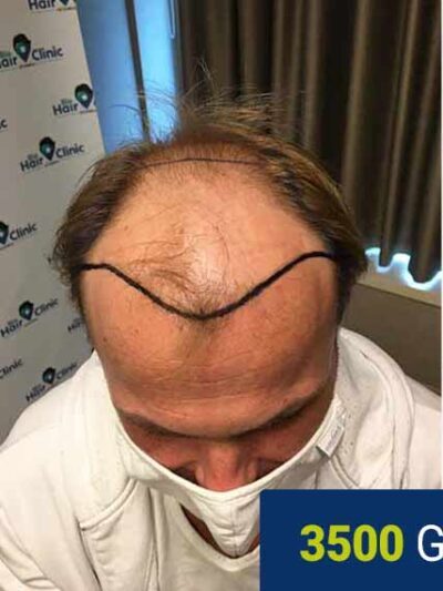 Patient before hair transplant — significant crown thinning