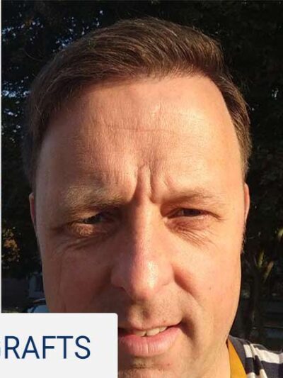 Same patient after hair transplant — hairline and temples restored