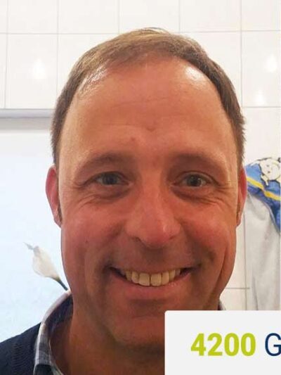 Patient before hair transplant — receding hairline and temple loss