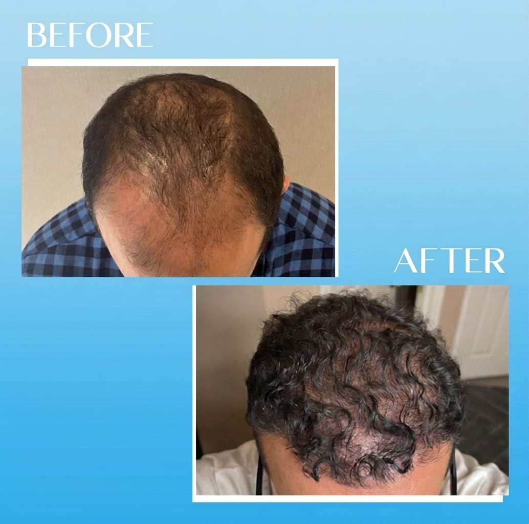 Hair transplant result