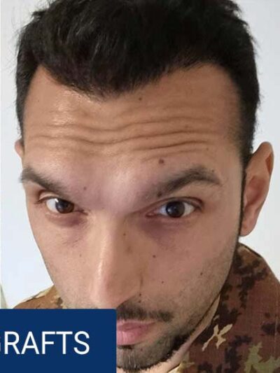 Same patient after hair transplant — density fully restored