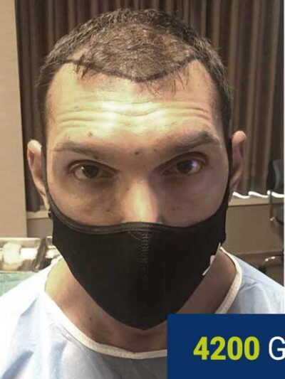 Patient before hair transplant — diffuse thinning across the top
