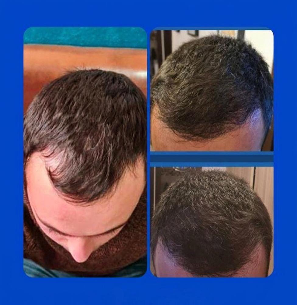 Hair transplant result